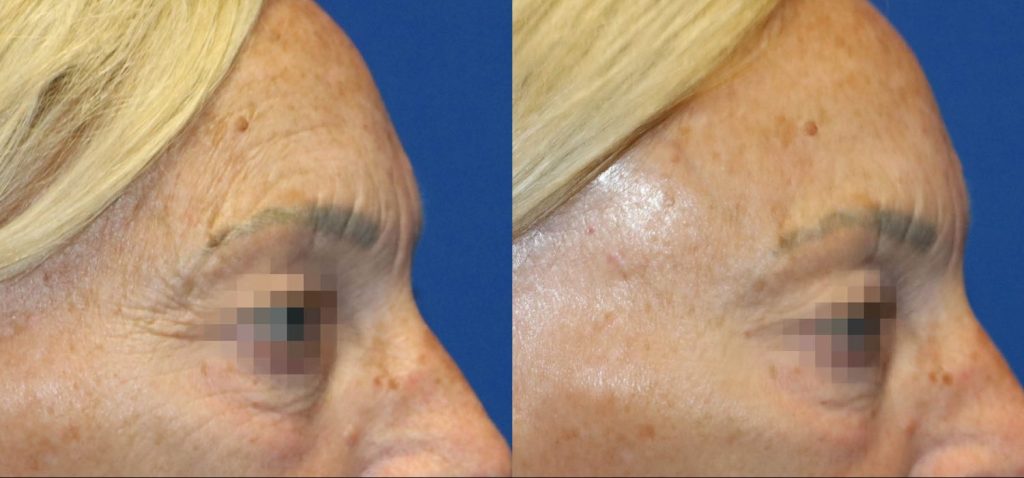 Before After Case 01