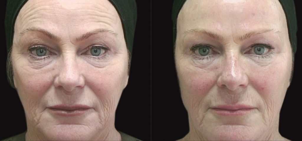 Before After Case 03