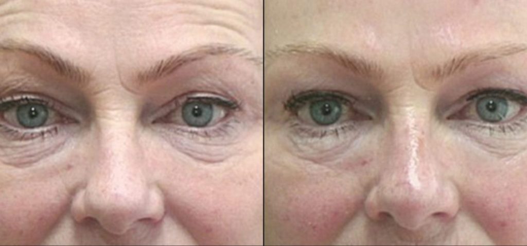 Before After Case 04