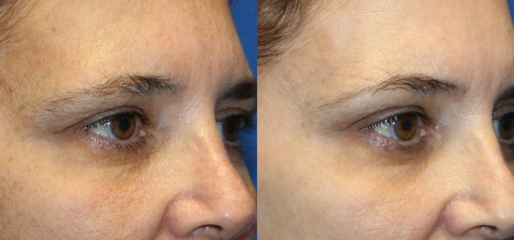 Before After Case 06